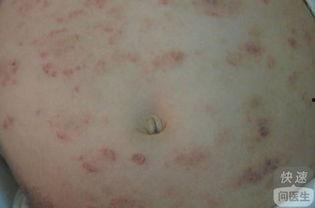 去除成人湿疹小妙招视频  第3张